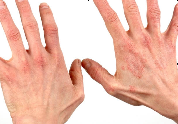 Фото дерматит на руках