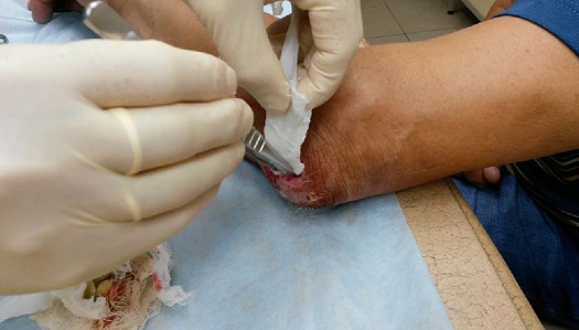 Фото наложение повязки стерильными диагностическими перчатками